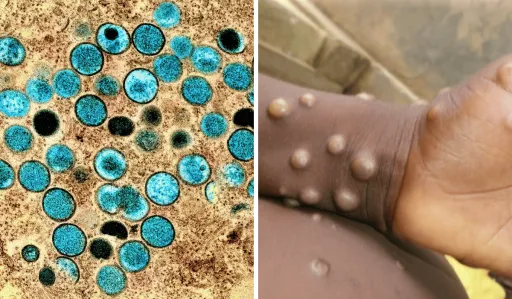 image for article Mpox in the Philippines: What Travellers Need to Know About the Latest Cases