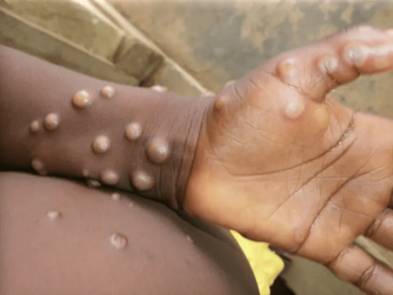 Monkey Pox 