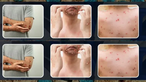 image for article Mpox in the Philippines: Travel Precautions for 2025